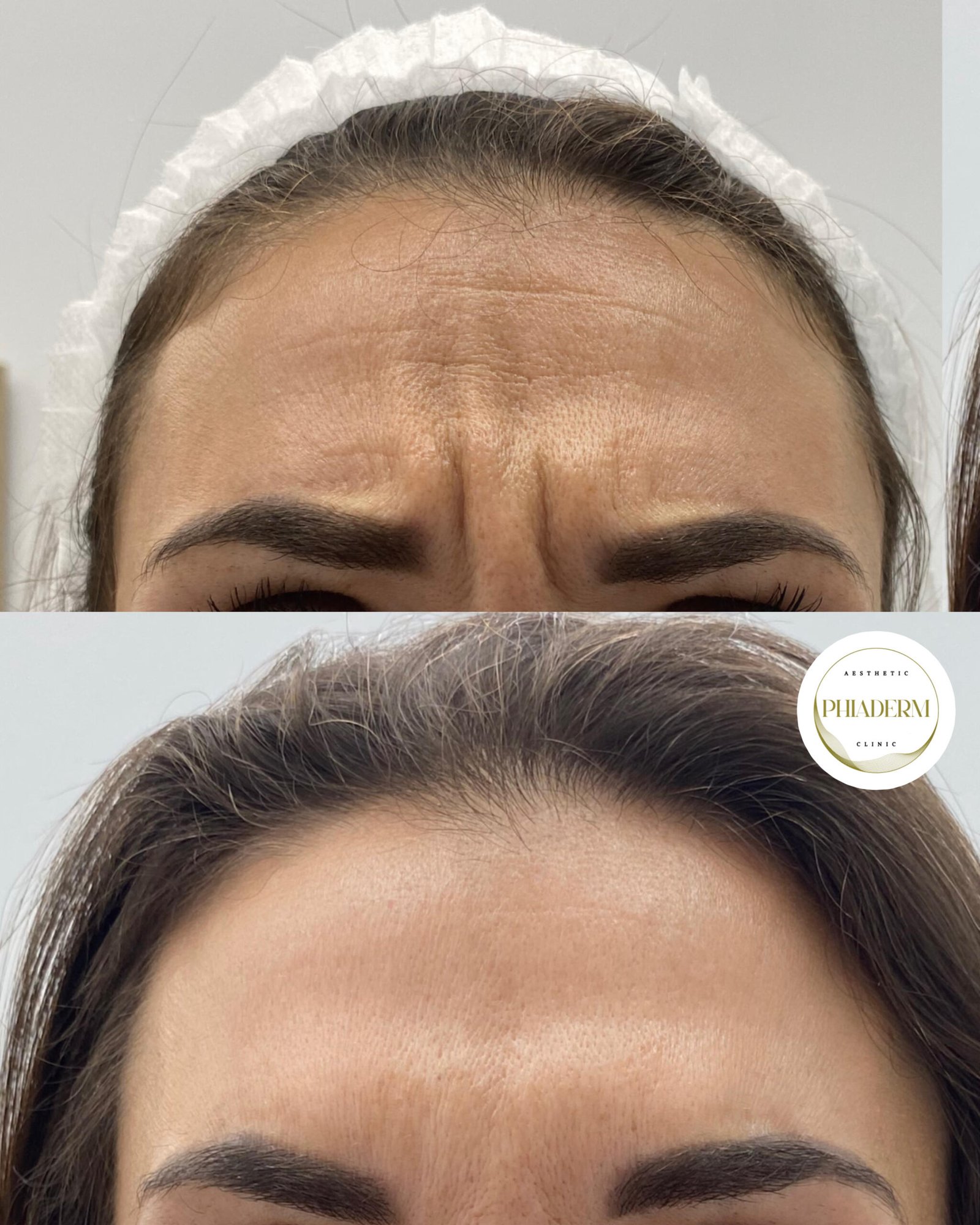 neuromoduladores clinica estetica phiaderm