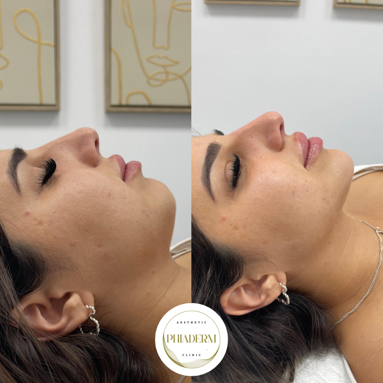 armonizacion facial clinica estetica phiaderm