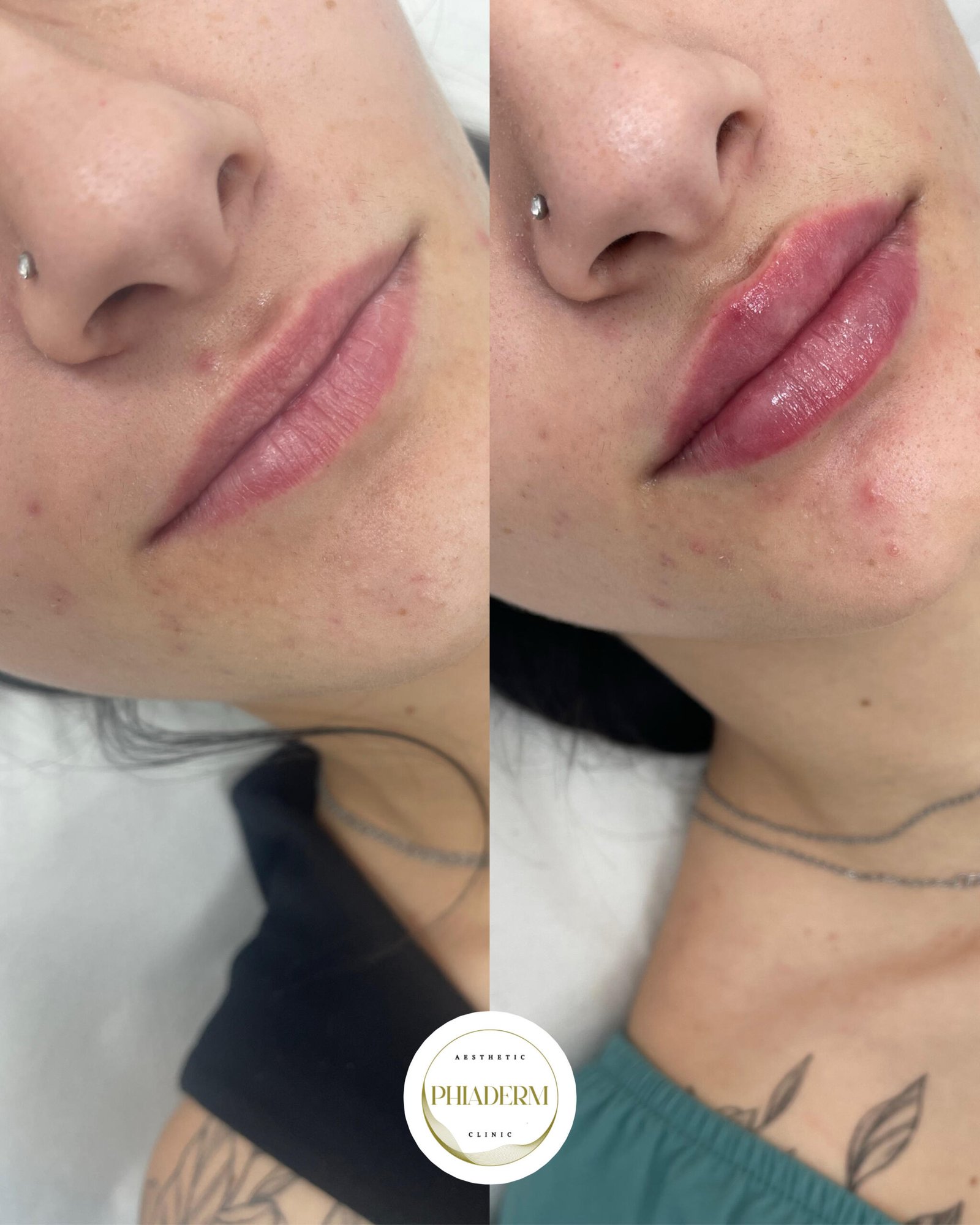 aumento de labios clinica estetica phiaderm
