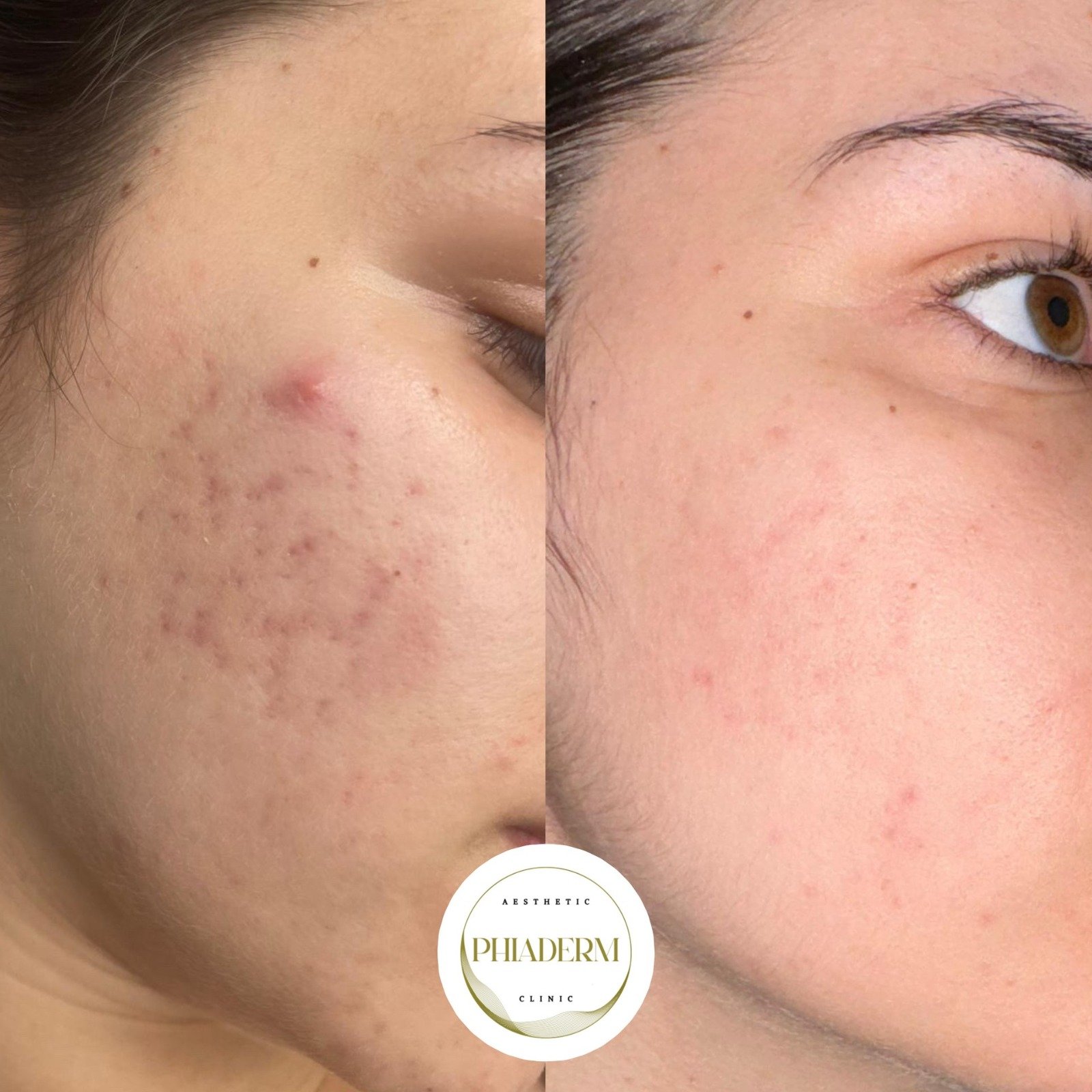 antes y después exoxomas